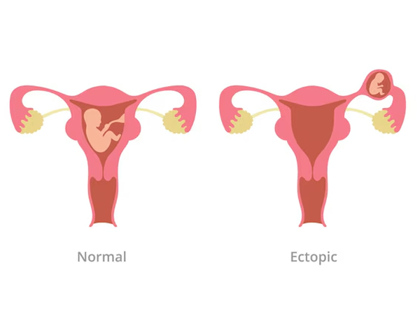 Ectopic Pregnancy