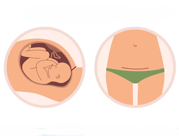 Caesarean Section