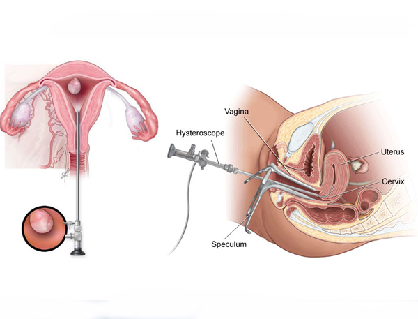 Hysteroscopy
